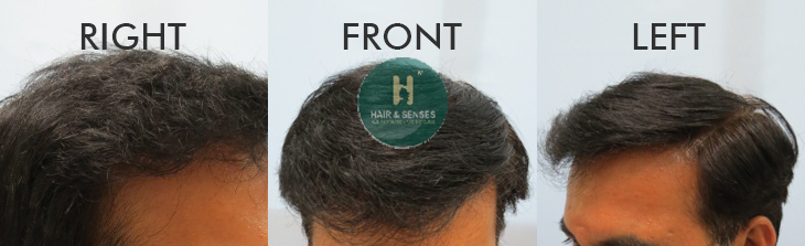 Hair Growth after 11 Months